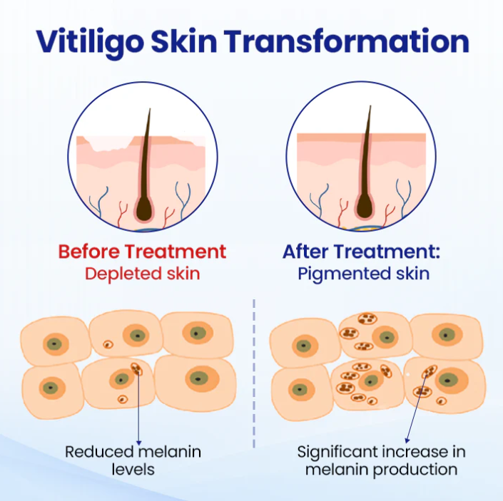 Lovilds® Vitiligo Treatment Spray