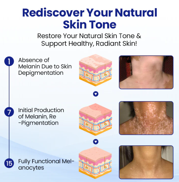 Lovilds® Vitiligo Treatment Spray