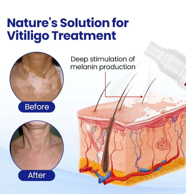 Lovilds® Vitiligo Treatment Spray