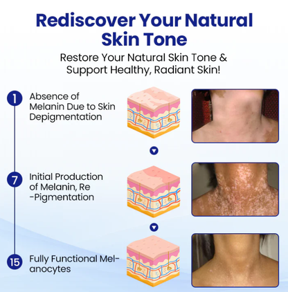 Lovilds® Vitiligo Treatment Spray